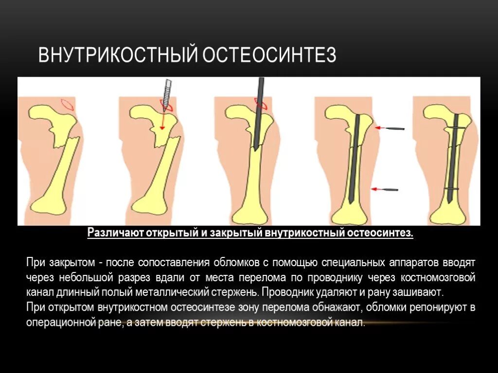 Оперативное лечение перелома костей. Интрамедуллярный остеосинтез штифтом. Интрамедуллярный спицевой остеосинтез. Остеосинтез лучевой кости стержнем. Внутрикостный остеосинтез большеберцовой кости.