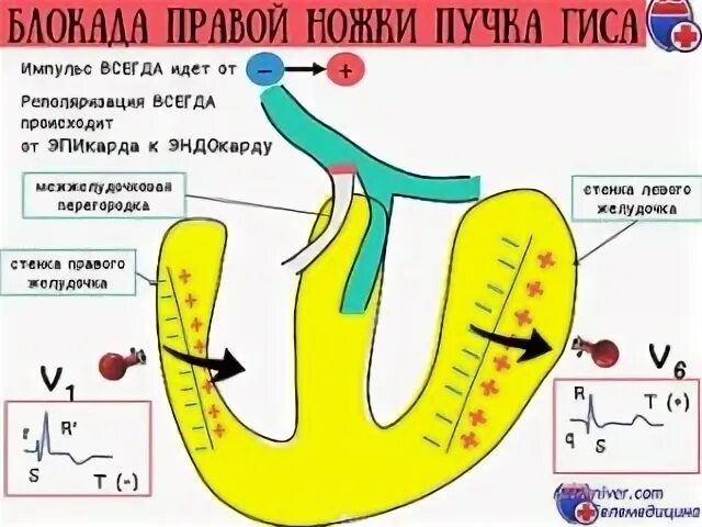 Блокада ножек пучка гиса отзывы