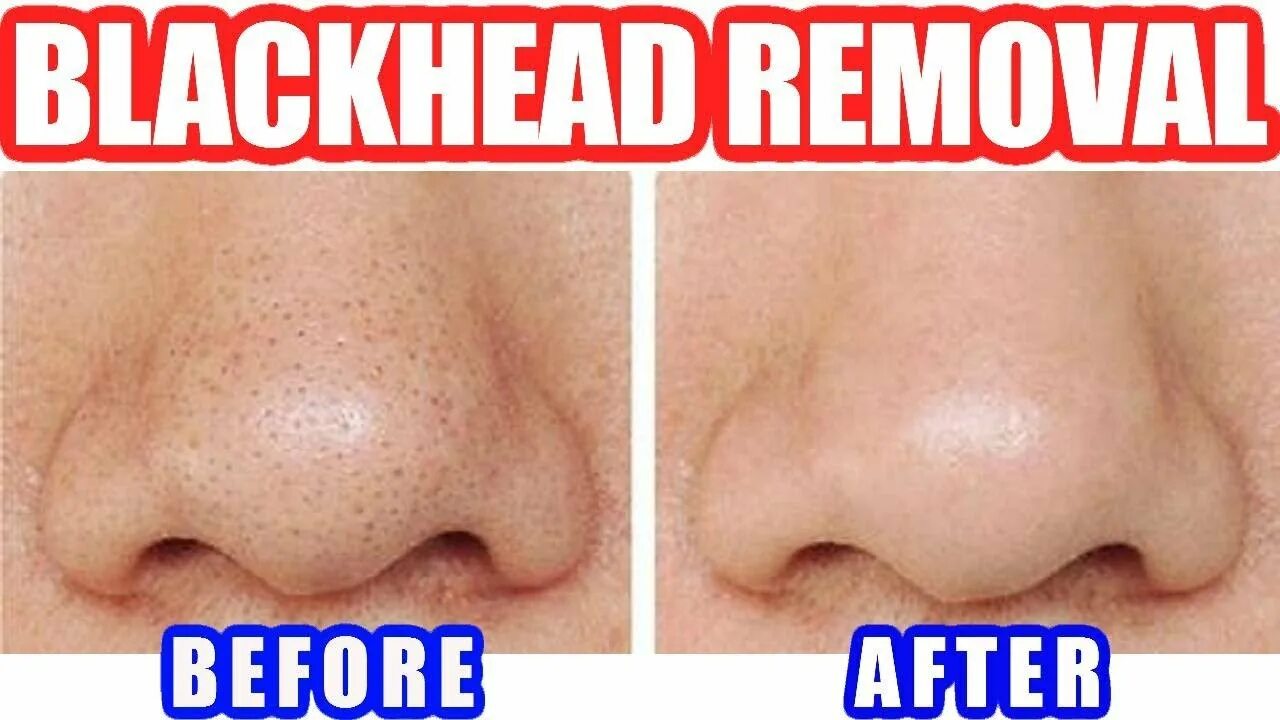 Blackhead Remover Moisturizing Pores полоски.