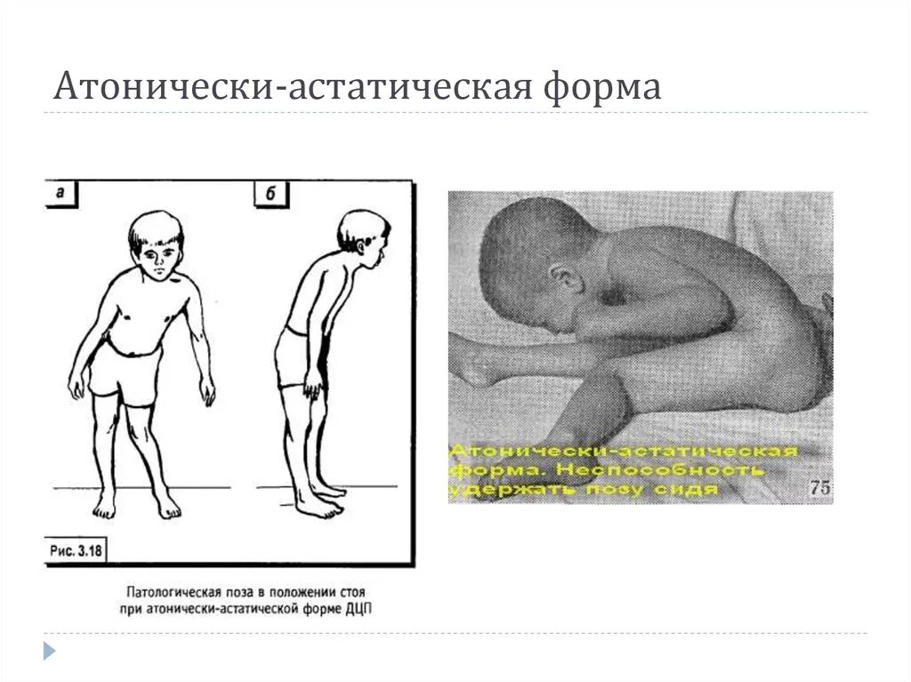 Дцп атонически астатическая. Атонически-астатическая форма дцп. дцп атонико-астатическая форма симптомы. дистоническая форма дцп. характеристики атонически-астатической формы дцп.