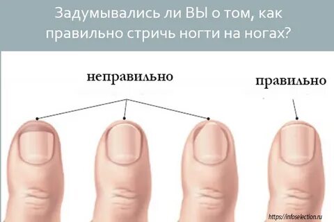 Как правильно подстригать большой ноготь на ноге