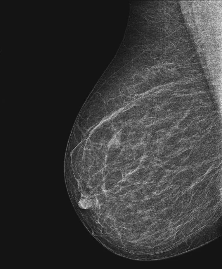 Фиброма в груди. Опухоль молочной железы маммограмма. Молочная железа маммография. Маммограмма фиброаденома. Фиброаденома молочной железы маммография.