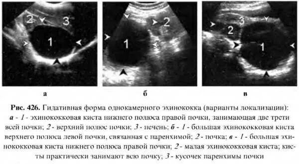 Эхинококкоз кисты почек. Эхинококкоз селезенки на УЗИ.