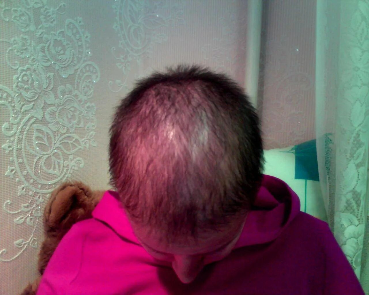 Волосы на голове после химиотерапии. Волосы после химиотерапии. Выпадение волос после химии. Выпадение волос после химиотерапии.