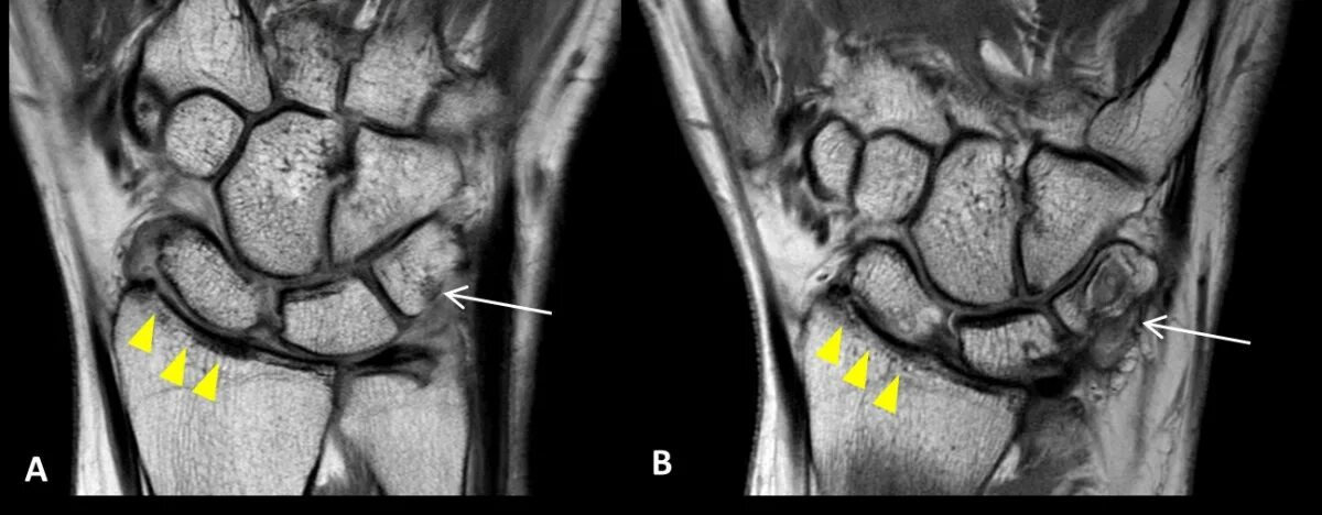 Артрит кт. Синовит лучезапястного сустава мрт. Триангулярный фиброзно-хрящевой комплекс. Анатомия лучезапястного сустава мрт. Ревматоидный артрит лучезапястного сустава мрт.