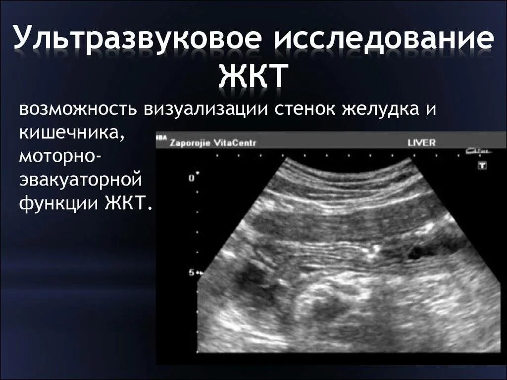 УЗИ Толстого кишечника при патологии. Ультразвуковое исследование желудка. На узи виден желудок