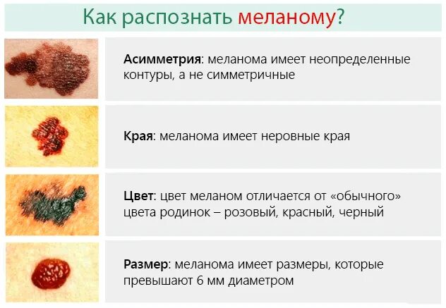 Как отличить плохую. Раковая опухоль меланома. Меланома кожи проявления. Меланома злокачественное новообразование. Злокачественные образования кожи меланома.