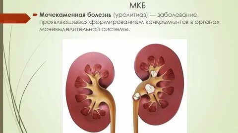 Уролитиаз это