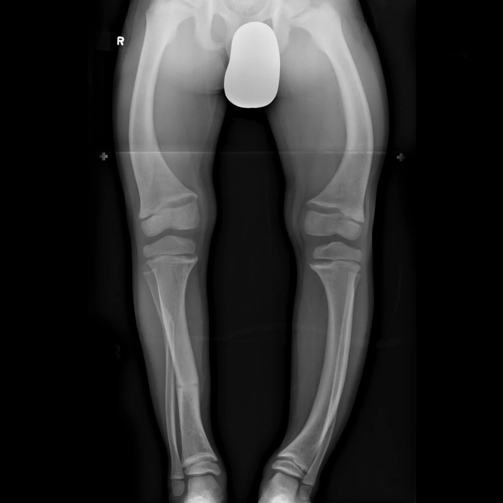 Остеомаляция кости на рентгене. Xray extension