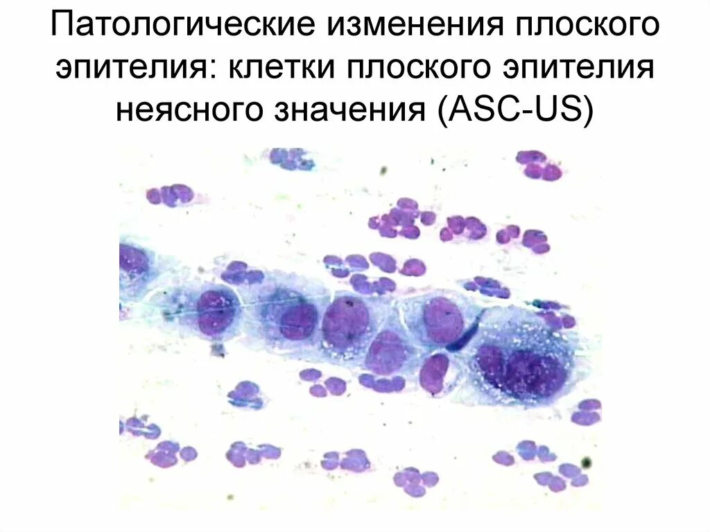 Атипичные клетки плоского эпителия неопределенного значения. Атипия клеток плоского эпителия. Дискариоз клеток плоского эпителия шейки матки что это такое. Плоский эпителий микроскопия. Клетки метаплазированного эпителия с реактивными изменениями