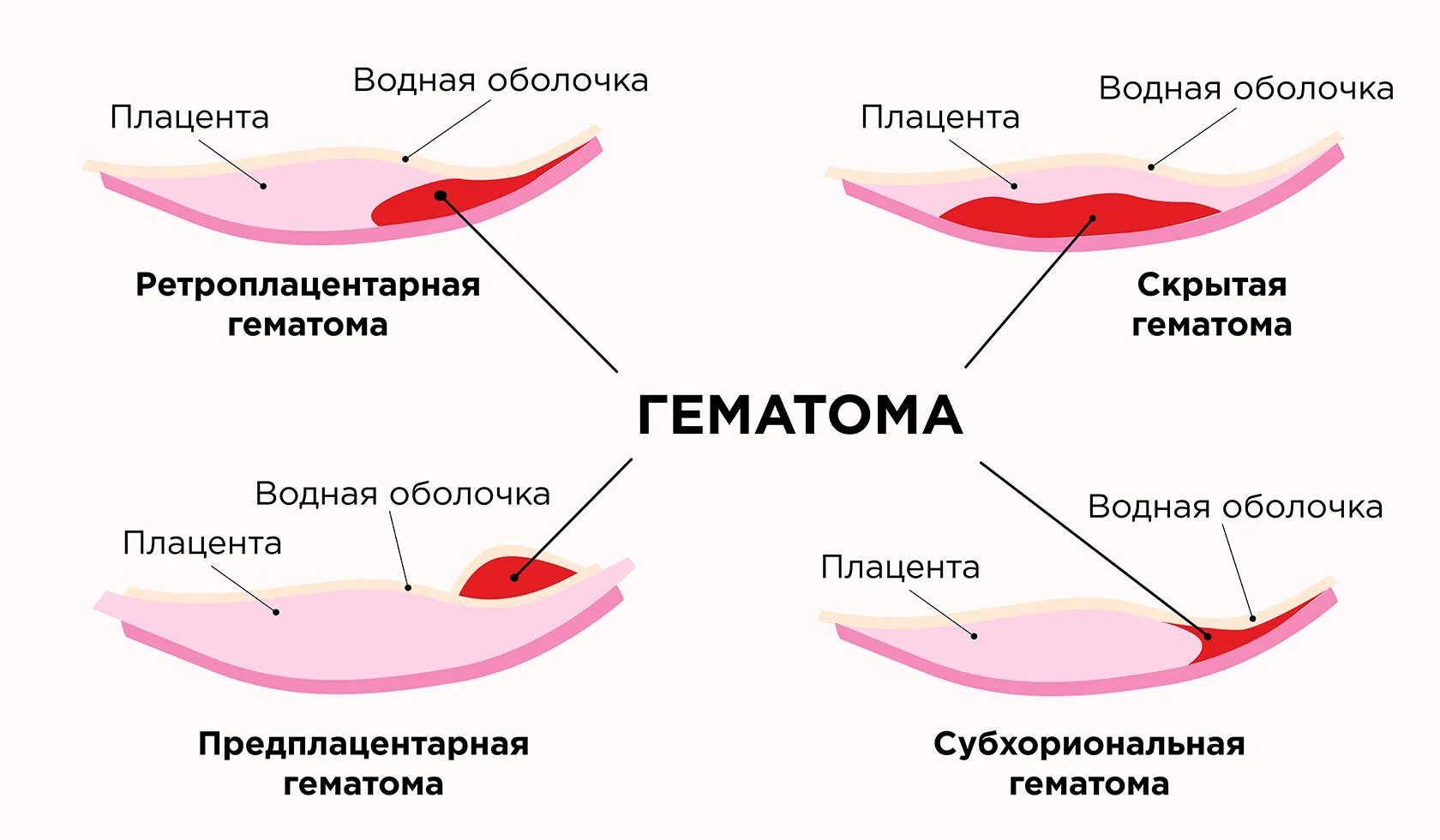 Кесарево выделения норма. Гематома плаценты при беременности. Отслойка плаценты гематома. Краевая гематома плаценты.