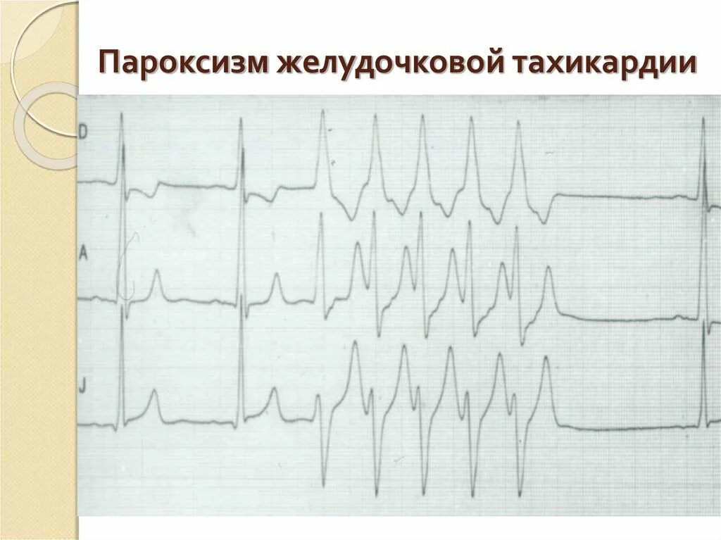 Желудочковая тахикардия на экг. Пароксизм желудочковой тахикардии ЭКГ. Пароксизмальная желудочковая тахикардия. Пароксизм ЖТ на ЭКГ. При пароксизмальной желудочковой тахикардии:.