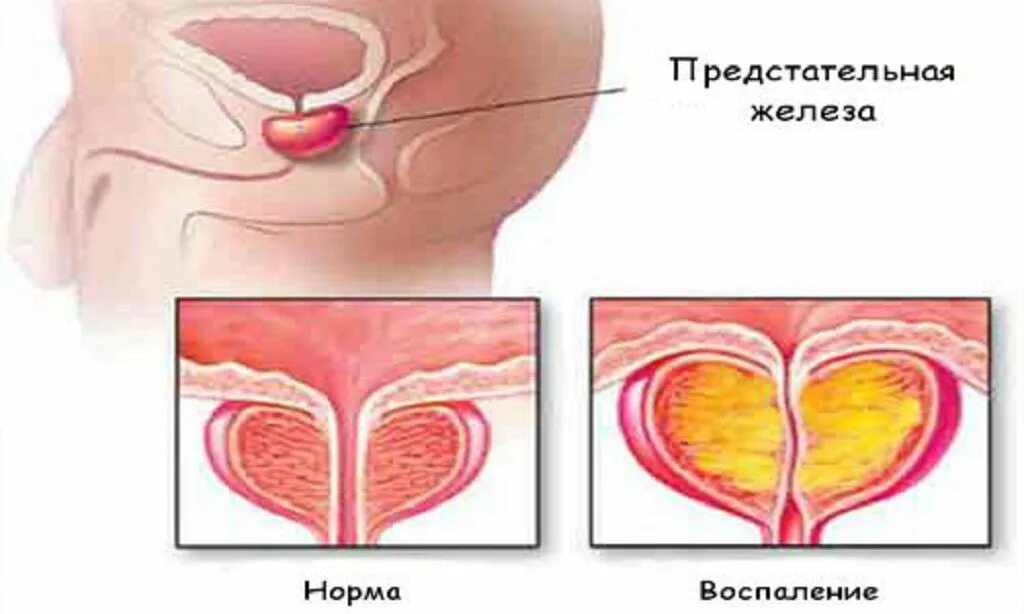 Воспалить простату. Воспаление предстательной железы. Простата у мужчин. Воспалительные заболевания предстательной железы. Воспаленная железа предстательная железа.