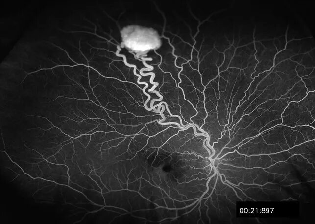 Болезнь гиппеля линдау. Болезньгиппеля динаду. Синдром фон. Синдром фон. Синдром фон.