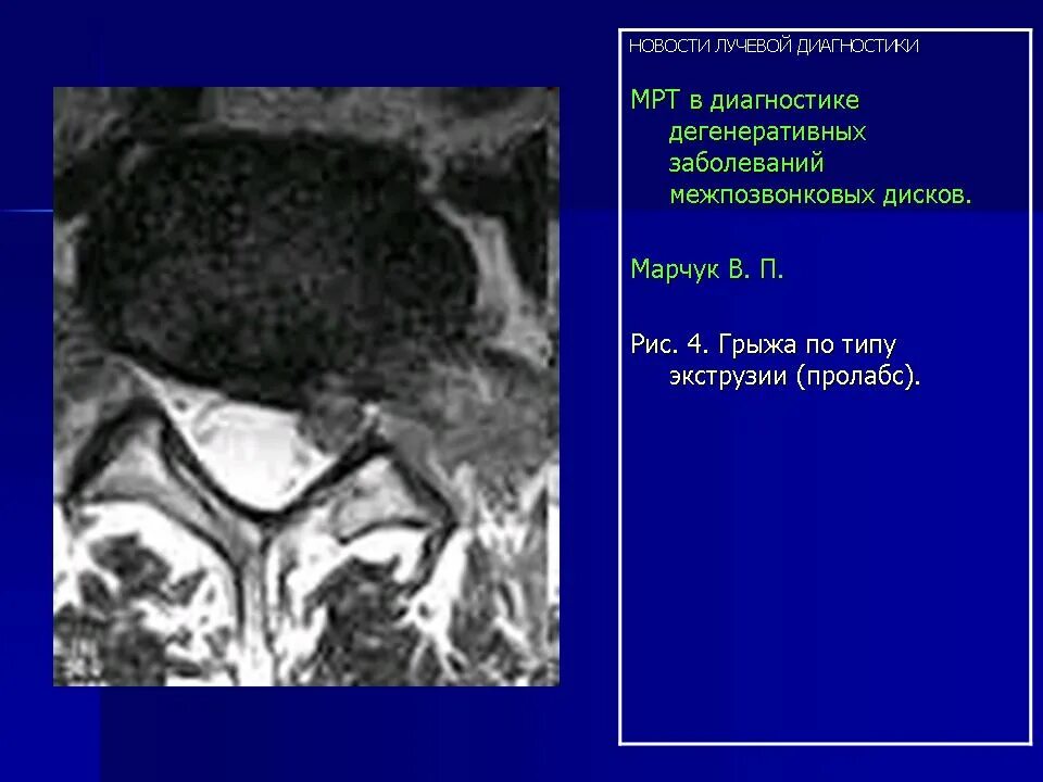 Дегенеративные поражения позвоночника. Дегенеративные изменения межпозвонковых дисков мрт. Лучевая диагностика заболеваний межпозвонковых дисков. Лучевая диагностика дегенеративно-дистрофических заболеваний. Лучевая диагностика дегенеративных изменений позвоночника.