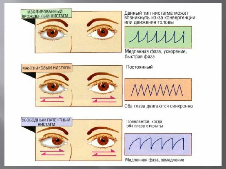 Горизонтальный и вертикальный нистагм. Нистагм левого глаза. Нистагм головы и глаз. Нистагм глаз причины.