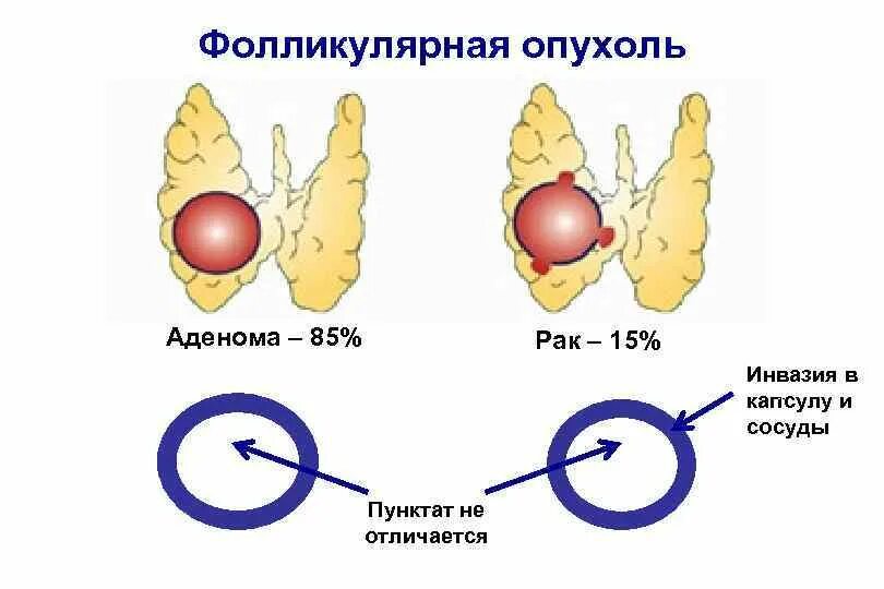 Фолликулярная опухоль щитовидной. Фолликулярная аденома ЩЖ. Фолликулярная в клеточная опухоль что это. Фолликулярные новообразования в щитовидной железе. Опухоль в капсуле