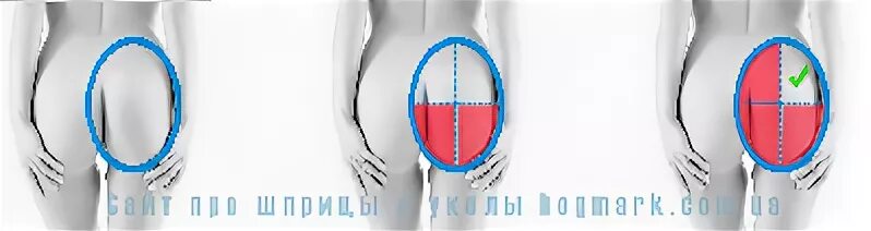 Куда в ягодицу