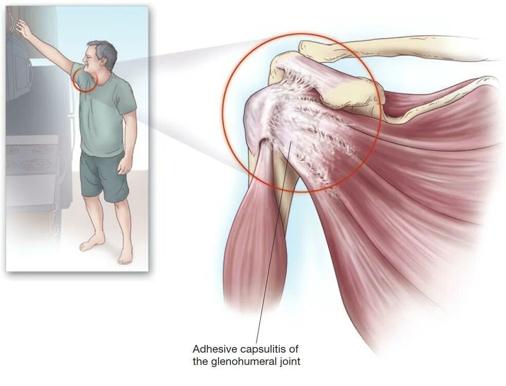 Капсулит симптомы и лечение. Вращательная манжета плечевого сустава мышцы. Тендинит мышцы плечевого сустава. Тендинопатия вращательной манжеты плечевого сустава. Вывих сухожилия двуглавой мышцы плеча.