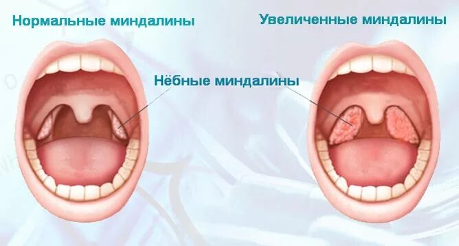 Что вызывает боль при глотании, при отсутствии боли в горле