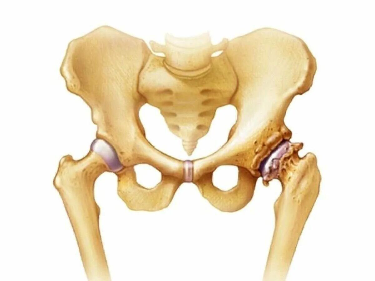 Медицина суставы тазобедренный. Коксартроз тазобедренного сустава. Коксалгия тазобедренного сустава. Кокриортоз тазабедрынов суставов. Коксартроз (артроз тазобедренного сустава).
