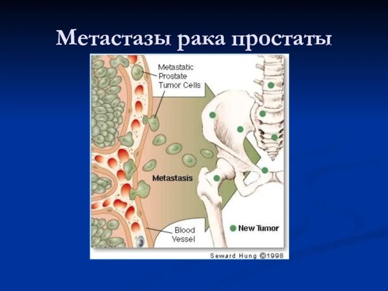Регионарные метастазы при раке. Отдаленные метастазы предстательной железы. метастазирование опухолей костей. метастазы простаты в кости.