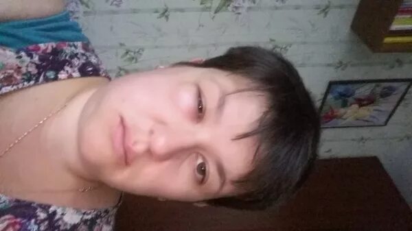 Сколько держится отек после удаления мудрости