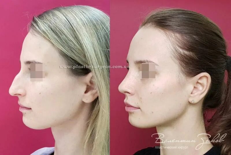 подставка для ноги при переломе. реабилитация при переломе лодыжки. сколько реабилитация после снятия гипса. перелом предплечья реабилитация. разработка сустава после перелома лодыжки.