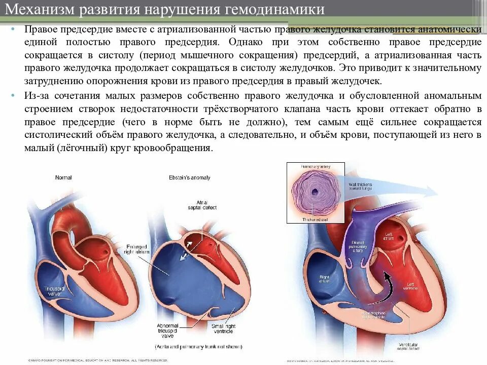 Предсердие болезни. Аномалия Эбштейна сердца. Врожденный порок сердца Эпштейна. Порок сердца Эбштейна врожденный. Болезнь Эбштейна врожденный порок сердца.