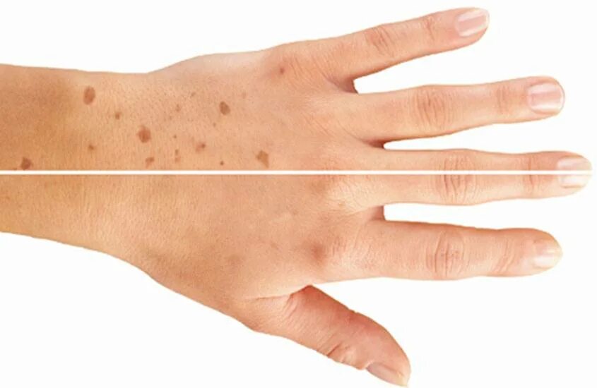 Избавление от пигментных пятен на лице. Пигментные пятна нарукаъх. Пятна на руках как избавиться. Возрастные пигментные пятна. Средство от избавления пигментных пятен.