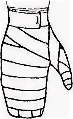 Техника наложения повязки перчатка. Перевязка варежка алгоритм. Рыцарская перчатка десмургия. Техника наложения повязки варежка. Техника наложения возвращающейся повязки на кисть.