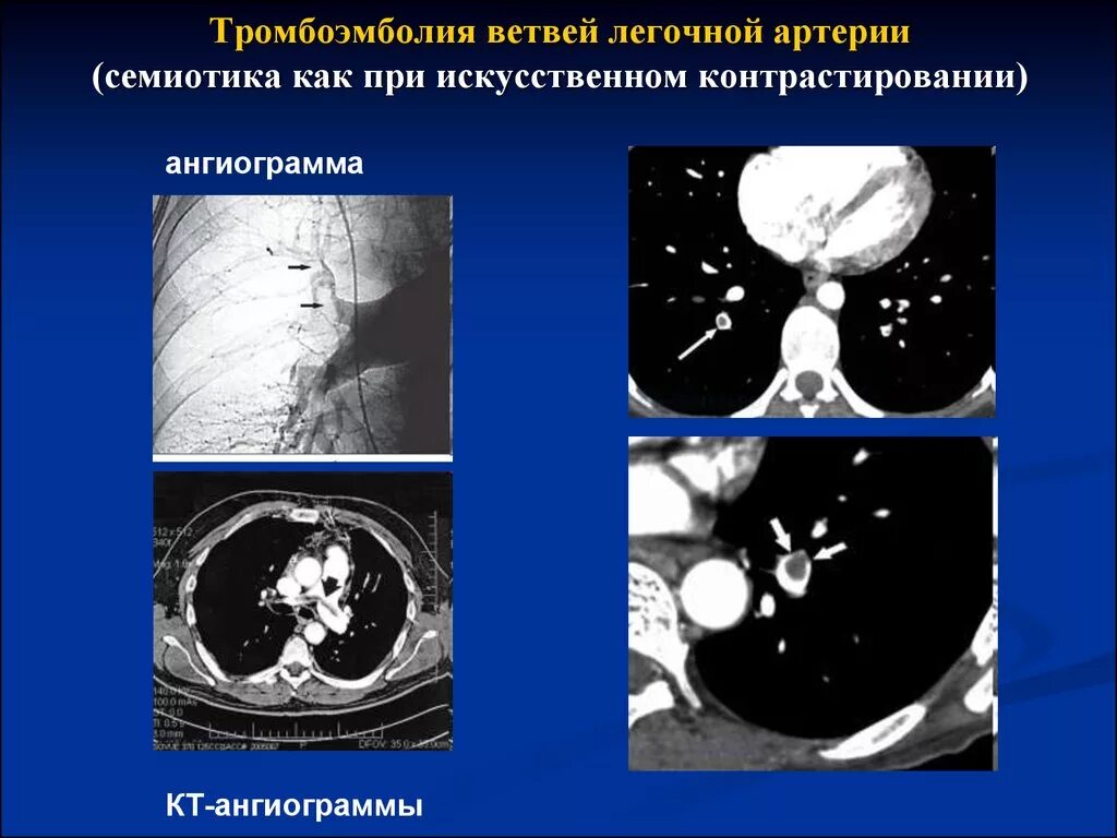 Тромбоэмболия мелких легочных ветвей. Клиника Тэла легочной артерии. Легочная тромболемия. Эмболия мелких ветвей легочной артерии. Тромбоэмболия ветвей легочной артерии.