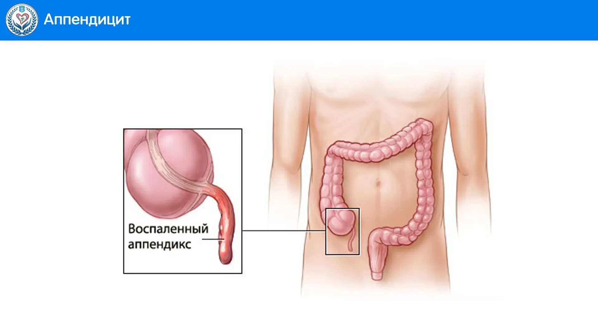 Послеоперационная грыжа аппендикс. Воспаленный аппендицит.