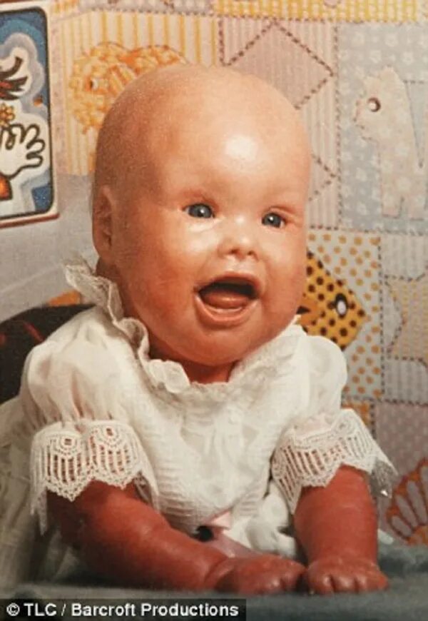 Стефани с ихтиозом арлекина. Ихтиоз арлекино у новорожденных. Ихтиоз синдром арлекина. Ихтиоз арлекина харпер. Пикассо портрет сына в костюме арлекина.