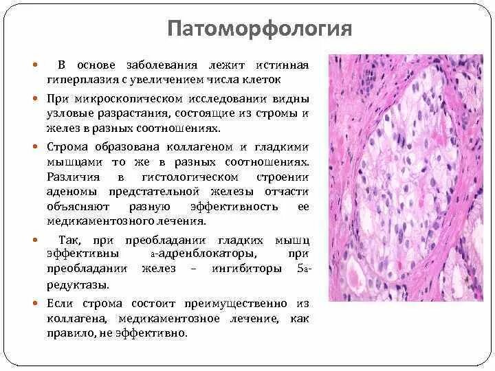 Железисто стромальная гиперплазия предстательной железы