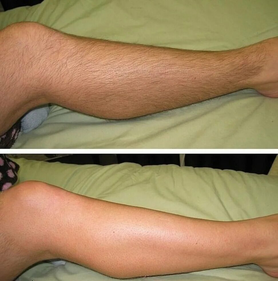 Эпиляция после бритья. Восковая эпиляция ног до и после. Депиляция голени.