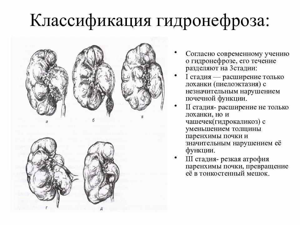 Увеличены почки у взрослого причины. Гидронефроз левой почки 2ст. гидронефроз классификация.