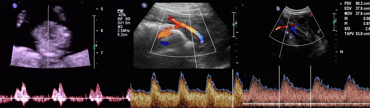 Сма плода. УЗИ допплерометрия плода. Допплерометрия сосудов плода. Допплерометрия венозного протока.