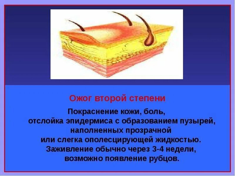 Как обрабатывать ожог после пузыря. Стадии заживания ожога 2 степени.