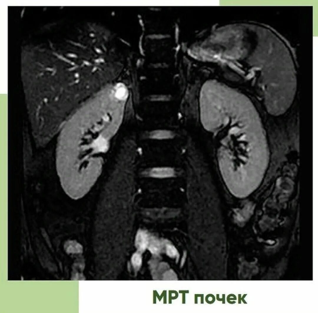 магнитно-резонансная урография камни в почках. мрт почек с контрастированием. добавочная долька почки мрт. кт почек с контрастированием норма. ахалазия мочеточника кт.