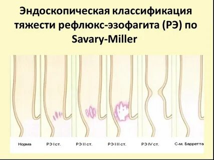 Стадии эзофагита