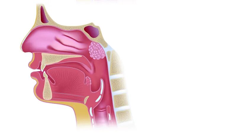 анатомия носоглотки аденоиды. разрастание глоточной миндалины. гипертрофия носоглоточной миндалины. аденоиды аденоидные вегетации 2 степени. глоточная миндалина аденоиды.