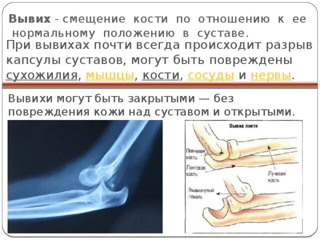 Вывих повреждения растяжения. Перелом вывих растяжение. Подвывих локтевого сустава.