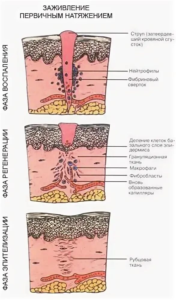 Стадии заживления после. Стадии заживления РАН после операции. Стадии заживления РАН И швов. Этапы заживления послеоперационных швов. Шов после операции стадии заживления.
