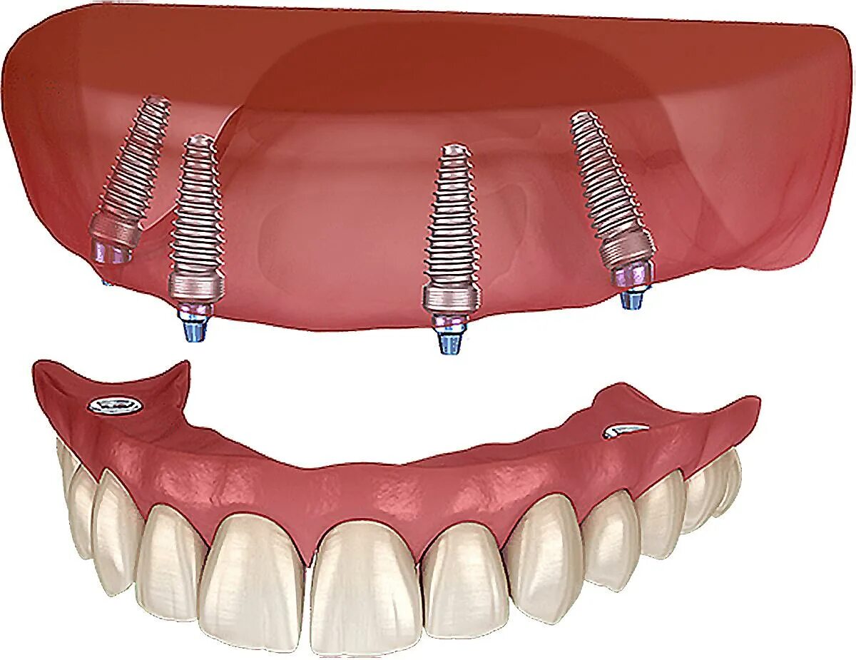 Имплантация зубов по технологии «all on 4». Имплантация зубов all on 6