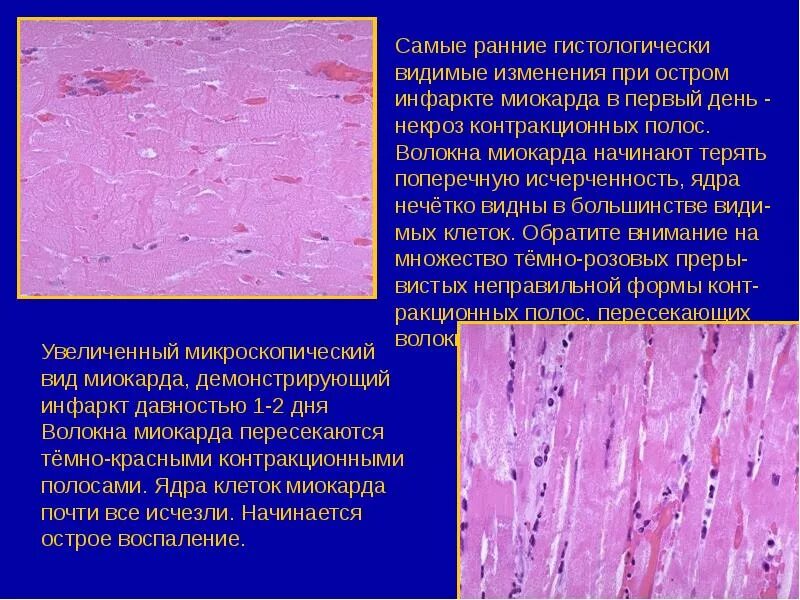Атеросклероз аорты препарат. Инфаркт ишемический миокарда микропрепарата. препарат острый инфаркт миокарда гистология. инфаркт миокарда патанатомия микроскопия. острый инфаркт миокарда препарат патанатомия.