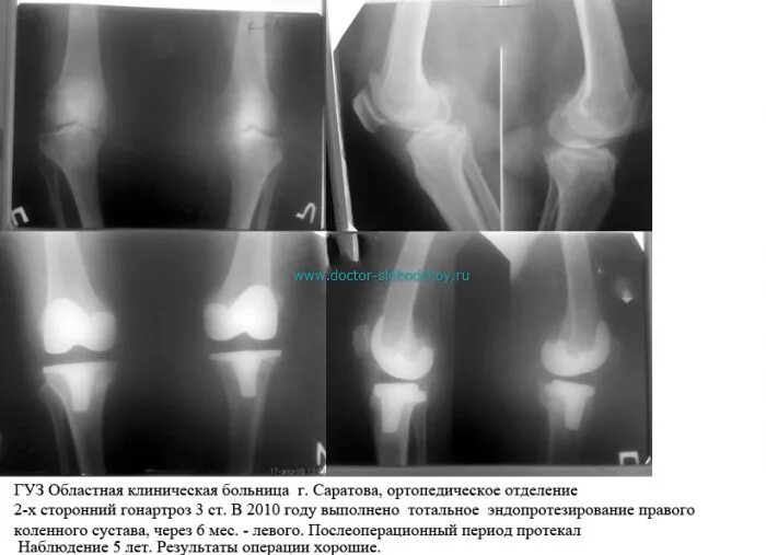 Нестабильность коленного сустава симптомы. Эндопротезирование коленного сустава рентген нестабильность. подвывих эндопротеза коленного сустава. нестабильность эндопротеза коленного сустава рентген. нестабильность эндопротеза коленного сустава на кт.