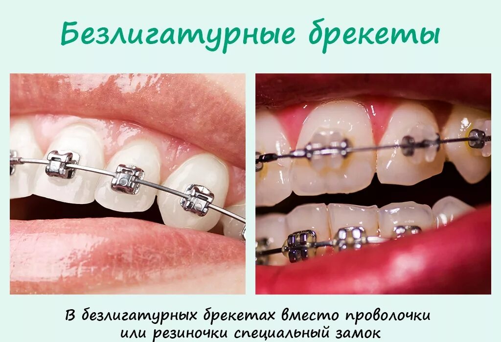 металлические брекеты лигатурные и безлигатурные. лигатурные и самолигирующие брекеты отличия. брекеты h4 самолигирующие металлические. самолигирующие (безлигатурные) брекеты. брекеты лигатурные металлические и безлигатурные отличия.