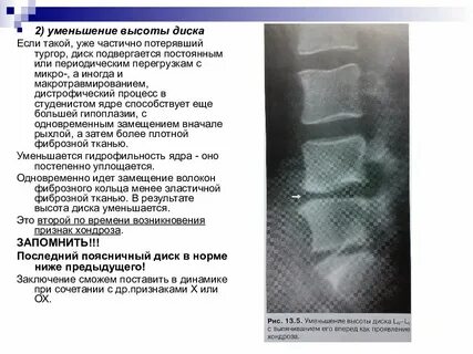 Дегенеративные изменения пояснично крестцового отдела что это