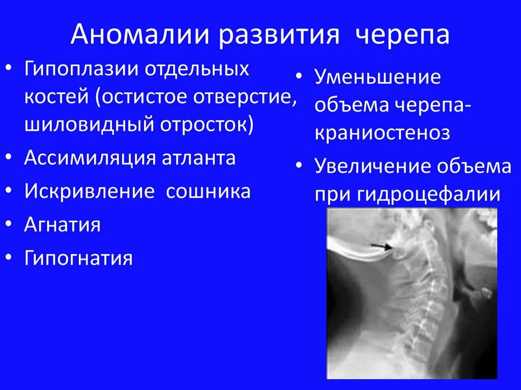 Аномалии развития называются. Аномалии развития черепа. Пороки развития костей черепа. Аномалии развития костей черепа анатомия. Пороки развития лицевого отдела черепа.